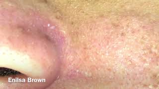 Acne Extractions/ Daryl Part 2
