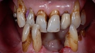 Immediate fixed Rehabilitation full arch with Toronto bridge Nobel Biocare dr.Giampiero Ciabattoni