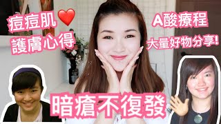 暗瘡不復發! A酸療程+多年護膚心得+推介好物| cheerS beauty【中字】
