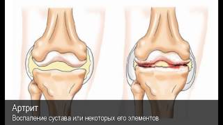 Артрит. Толковый Видеословарь русского языка