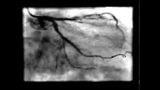 T STENT ТЕХНИКА ДЛЯ ЛЕЧЕНИЯ БИФУРКАЦИЙ СОСУДОВ СЕРДЦА