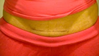 MY C-SECTION SCAR