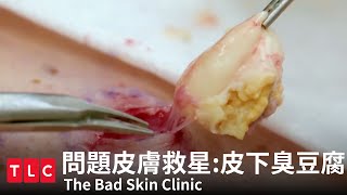 《問題皮膚救星》皮下臭豆腐，不定時爆炸！｜TLC 旅遊生活頻道