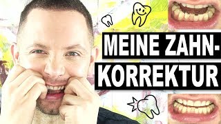 GERADE ZÄHNE MIT HARMONIESCHIENE – GREY YOUNG