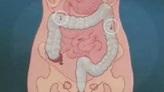 Barium enema