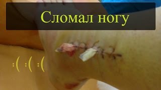 Перелом ноги, Перелом малой берцовой кости.