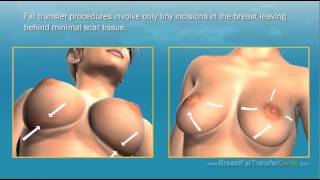 Breast Fat Transfer versus Breast Implants