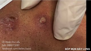 Nặn mụn nhọt, mụn bọc ở lưng đầy mủ| Squeeze super big pimples, blackhead, whitehead on the back