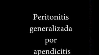 Peritonitis generalizada por apendicitis aguda perforada vía laparoscópica