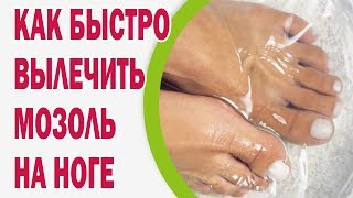 Как быстро вылечить мозоль на ноге