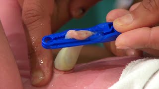 Chlorhexidine for Newborn Cord Care (Hausa) - Newborn Care Series