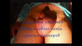 Симультанная операция циркумцизио и водянка