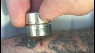Oddly satisfying videos | removing metal splinter on the skin with a magnet