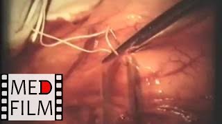 Хирургия язвенной болезни 12-перстной кишки © Surgery of peptic ulcer disease 12 duodenal ulcer