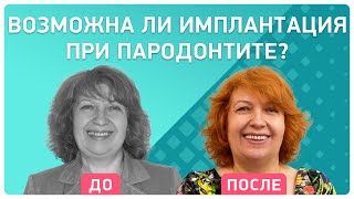 Базальная имплантация на фоне пародонтита ? отзыв пациентки об имплантации за 3 дня
