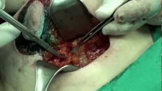 Operation 12 - Medial Mammoplasty 13m