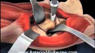 Hip Replacement Surgery