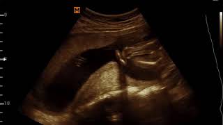 Sexo de mi bebe a las 19 semanas de embarazo / sexo niña