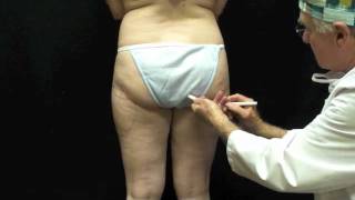 SmartLipo Demonstration Video Hips - Sherwood Baxt, MD, Paramus, NJ