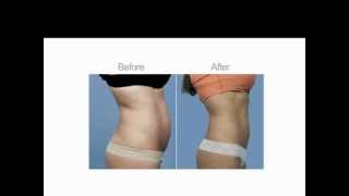 "Tite Fx" Weight Loss By LA GRÂCE CLINIC สลายไขมันถาวร