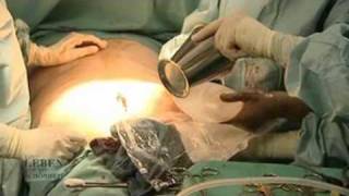 Dr. Dagmar Millesi - Povergrößerung mit Po-Implantaten