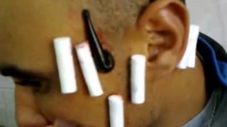 Therapy with leeches-blutegel -- pijavice- lintah- La terapia de sanguijuela- пиявки, 거머리-水蛭-6