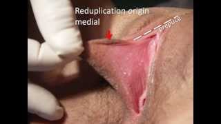 Cosmetic Vaginal Surgery Overview 2013