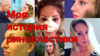 Моя история ринопластики, др. Тимур Кобулашвили