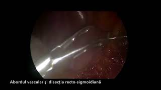 Operatie laparoscopica de cancer rectal | Spitalul Medicover