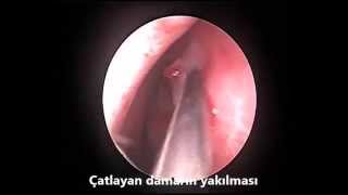 Burun kanamasında kanayan damarın yakılması