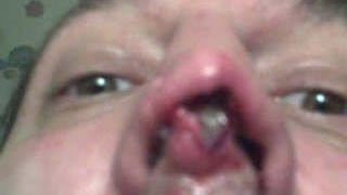 Body Piercing Infections
