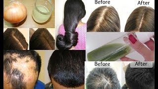 How To Use Onion Juice For Hair Regrowth | Dandruff | Hair fall Control | Premature Greying Of Hair