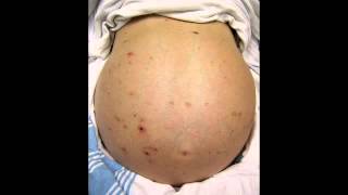 Budd-Chiari Syndrome, Familial Hypercholesterolemia