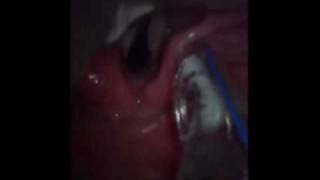 ビデオ喉頭鏡で経鼻挿管