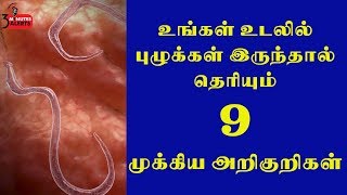 உங்கள் உடலில் புழுக்கள் இருந்தால் தெரியும் 9 அறிகுறிகள் / 3 MINUTES  ALERTS