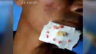 ГНОЙНИКИ НА ЛИЦЕ У ПАРНЯ ВМЕСТО КОЖИ! 18+
