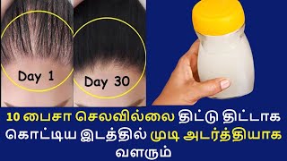 ஒரு வாரம் மட்டும் போதும் சொட்டை தலையிலும் முடி வேகமாக வளரும் | hair fall control hair growth tips