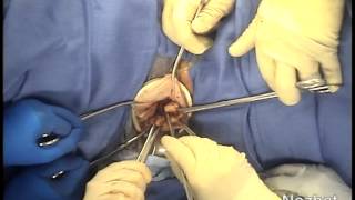 Enclosed Transvaginal Morcellation of an Enlarged Uterus