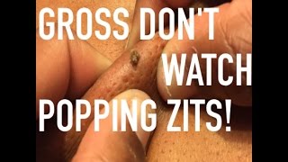 Zit Popping: AWESOME Mother's Day Gift