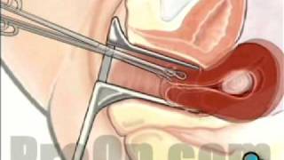 Myomectomy Vaginal Fibroid Removal, Patient Education