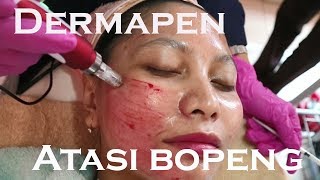 Menghilangkan bopeng dengan dermapen.