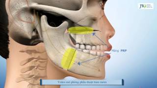 Điều trị khớp cắn ngược đúng cách và triệt để nhất | Bệnh viện thẩm mỹ JW hàn quốc