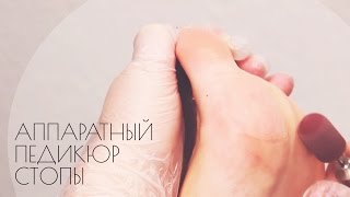 Аппаратный педикюр стопы