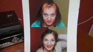 Feminizing Hair Transplant Transgender Woman Hair Line Restoration Dr. Diep www.mhtaclinic.com