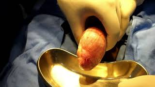 Hydrocele: Eversion of Sac