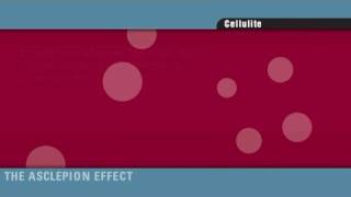 Cellulite-Behandlung mittels Akustischer Welle der Effect-Systeme von Asclepion