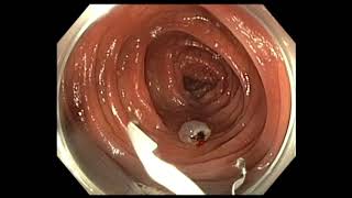 Colonoscopy: Colon Polyp with Cancer - which one needs surgery after EMR