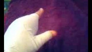 Finger Amputation