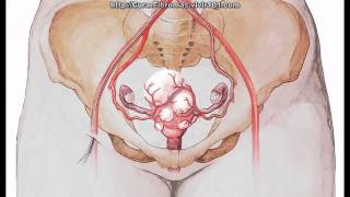 Fibromas Uterinos Tratamiento Natural - Como Curar Miomas En El Útero Con Remedios Naturales