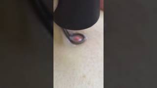 лазерное удаление гемангиомы аппаратом Кристалл